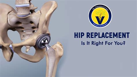 hip and knee surgery greenwich|Best Orthopedic Surgeons Near Me in Greenwich, CT .